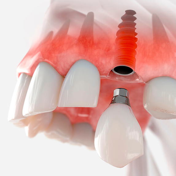 imagen Implantes